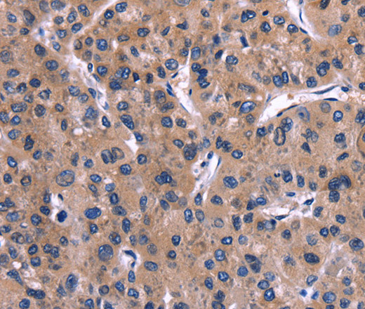 Immunohistochemistry of paraffin-embedded Human liver cancer tissue using IL1A Polyclonal Antibody at dilution 1:40