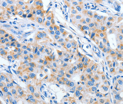 Immunohistochemistry of paraffin-embedded Human lung cancer using IMMT Polyclonal Antibody at dilution of 1:70