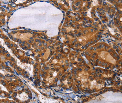 Immunohistochemistry of paraffin-embedded Human thyroid cancer using ILK Polyclonal Antibody at dilution of 1:50