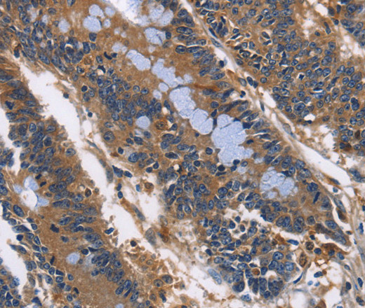 Immunohistochemistry of paraffin-embedded Human colon cancer using ILK Polyclonal Antibody at dilution of 1:50