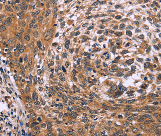 Immunohistochemistry of paraffin-embedded Human cervical cancer tissue using ING2 Polyclonal Antibody at dilution 1:60