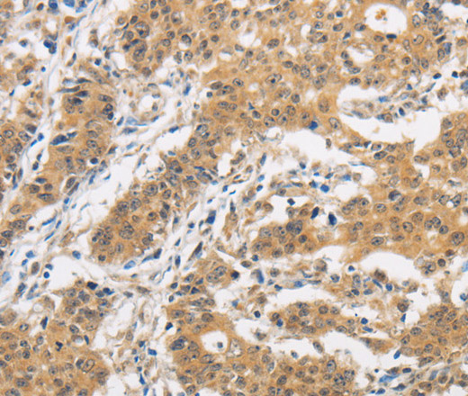 Immunohistochemistry of paraffin-embedded Human gasrtic cancer tissue using ITGB3BP Polyclonal Antibody at dilution 1:50