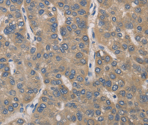 Immunohistochemistry of paraffin-embedded Human liver cancer tissue using IRAK4 Polyclonal Antibody at dilution 1:40