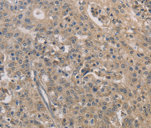 Immunohistochemistry of paraffin-embedded Human gastric cancer tissue using IRAK4 Polyclonal Antibody at dilution 1:40