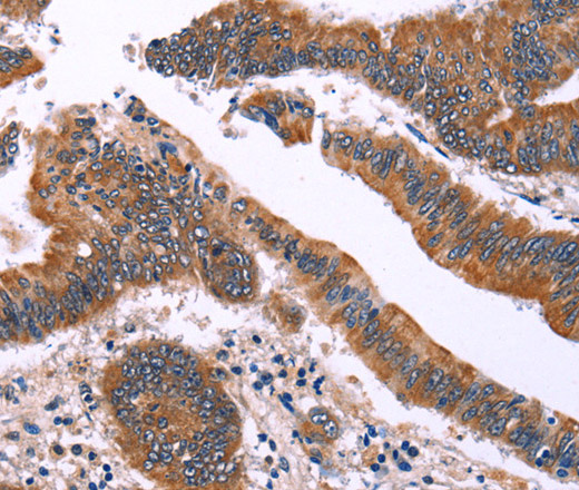 Immunohistochemistry of paraffin-embedded Human colon cancer using IRAK1BP1 Polyclonal Antibody at dilution of 1:40
