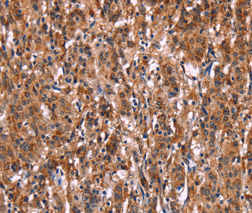 Immunohistochemistry of paraffin-embedded Human gasrtic cancer tissue using LILRB1 Polyclonal Antibody at dilution 1:50