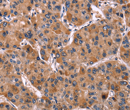 Immunohistochemistry of paraffin-embedded Human liver cancer tissue using LILRB1 Polyclonal Antibody at dilution 1:50