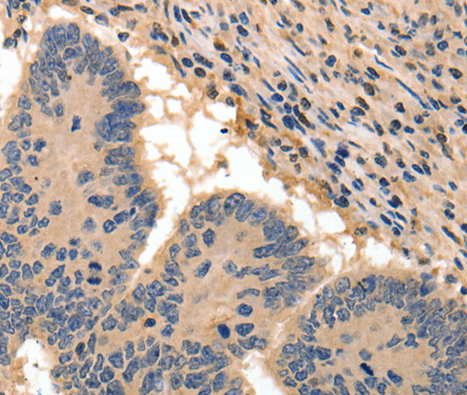Immunohistochemistry of paraffin-embedded Human colon cancer tissue using BAIAP2 Polyclonal Antibody at dilution 1:50