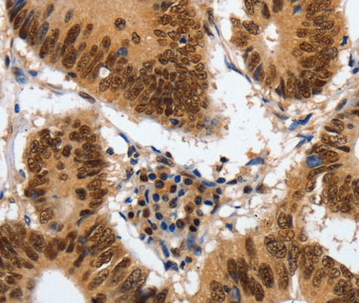 Immunohistochemistry of paraffin-embedded Human colon cancer using COPS5 Polyclonal Antibody at dilution of 1:120