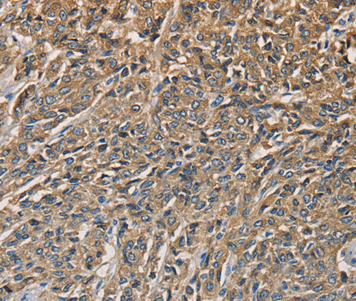 Immunohistochemistry of paraffin-embedded Human prostate cancer tissue using KLK1 Polyclonal Antibody at dilution 1:40
