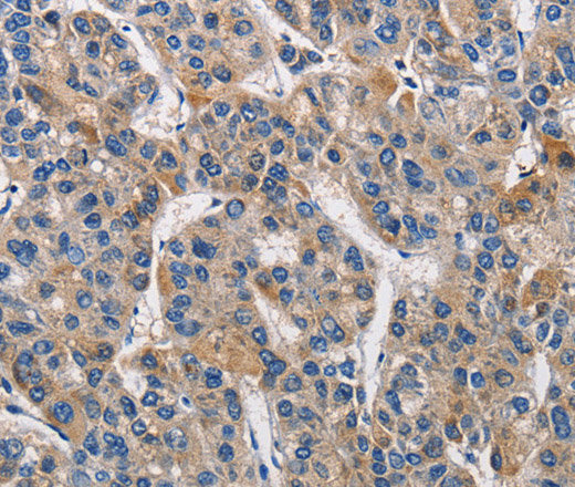 Immunohistochemistry of paraffin-embedded Human liver cancer tissue using KLK1 Polyclonal Antibody at dilution 1:40
