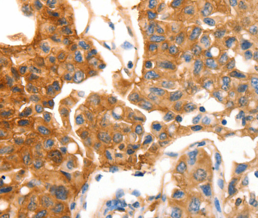 Immunohistochemistry of paraffin-embedded Human lung cancer using MVP Polyclonal Antibody at dilution of 1:30