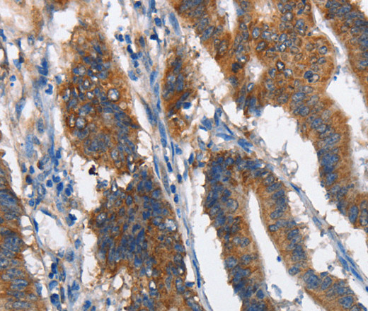 Immunohistochemistry of paraffin-embedded Human colon cancer tissue using MAD2L1BP Polyclonal Antibody at dilution 1:60