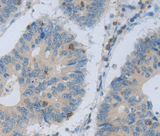 Immunohistochemistry of paraffin-embedded Human colon cancer using MAGEB4 Polyclonal Antibody at dilution of 1:40