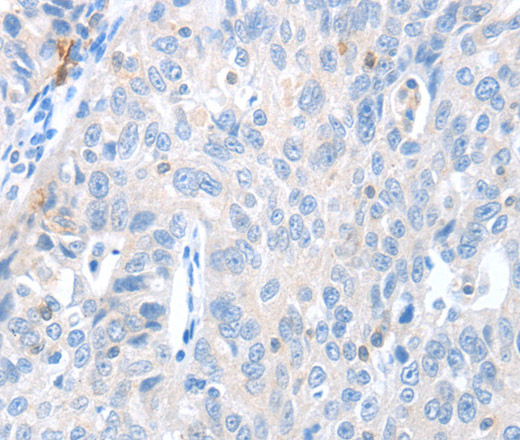 Immunohistochemistry of paraffin-embedded Human ovarian cancer using MAGEB4 Polyclonal Antibody at dilution of 1:40