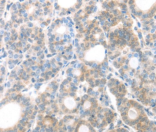 Immunohistochemistry of paraffin-embedded Human thyroid cancer using MAGED1 Polyclonal Antibody at dilution of 1:30