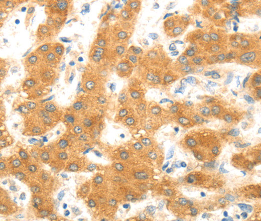 Immunohistochemistry of paraffin-embedded Human liver cancer using MAP2K6 Polyclonal Antibody at dilution of 1:30