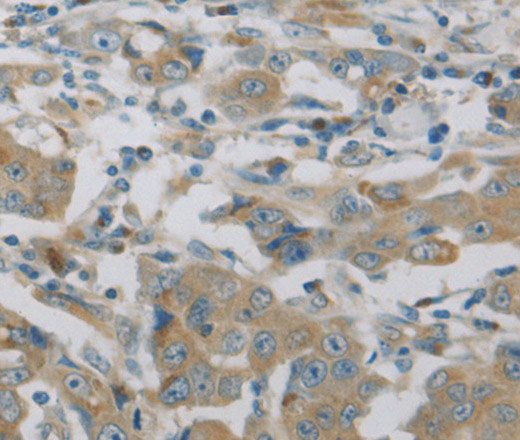 Immunohistochemistry of paraffin-embedded Human breast cancer using MAP2K6 Polyclonal Antibody at dilution of 1:30