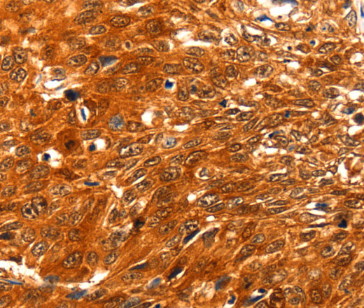 Immunohistochemistry of paraffin-embedded Human esophagus cancer using SERPINB5 Polyclonal Antibody at dilution of 1:60