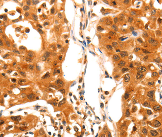 Immunohistochemistry of paraffin-embedded Human lung cancer using SERPINB5 Polyclonal Antibody at dilution of 1:60