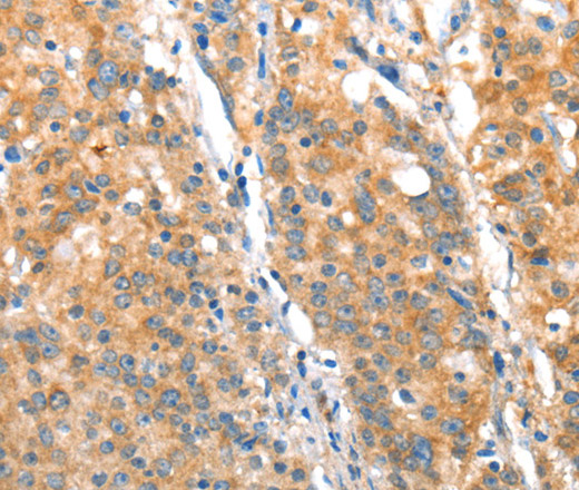 Immunohistochemistry of paraffin-embedded Human gasrtic cancer tissue using ST14 Polyclonal Antibody at dilution 1:70