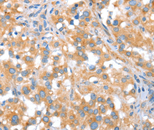 Immunohistochemistry of paraffin-embedded Human thyroid cancer tissue using ST14 Polyclonal Antibody at dilution 1:70