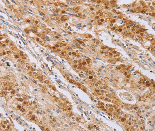 Immunohistochemistry of paraffin-embedded Human gastic cancer using CDC46 Polyclonal Antibody at dilution of 1:40