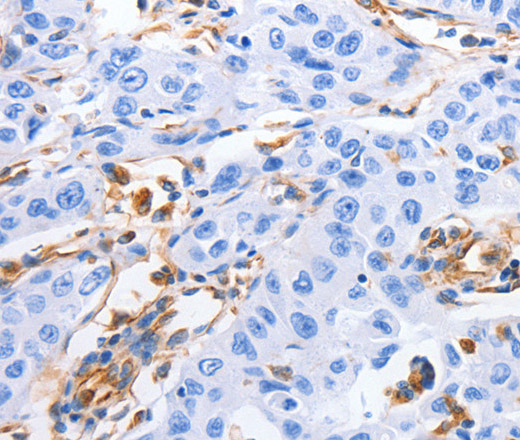 Immunohistochemistry of paraffin-embedded Human lung cancer tissue using MFN1 Polyclonal Antibody at dilution 1:60