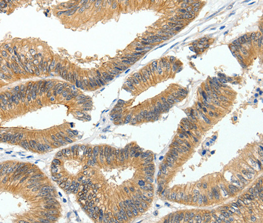 Immunohistochemistry of paraffin-embedded Human colon cancer tissue using MDK Polyclonal Antibody at dilution 1:60