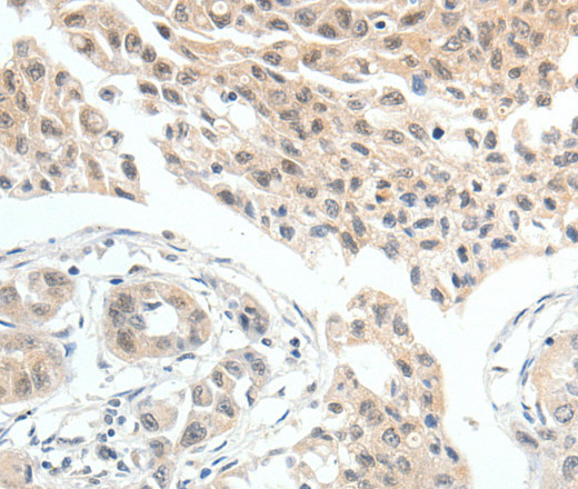 Immunohistochemistry of paraffin-embedded Human lung cancer tissue using MDK Polyclonal Antibody at dilution 1:60