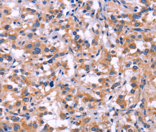 Immunohistochemistry of paraffin-embedded Human thyroid cancer tissue using MMP14 Polyclonal Antibody at dilution 1:40