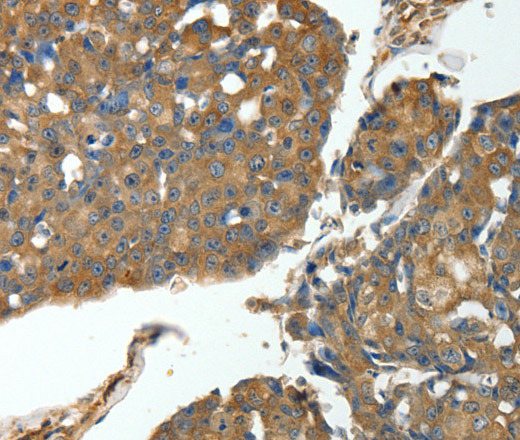 Immunohistochemistry of paraffin-embedded Human breast cancer using MSN Polyclonal Antibody at dilution of 1:30