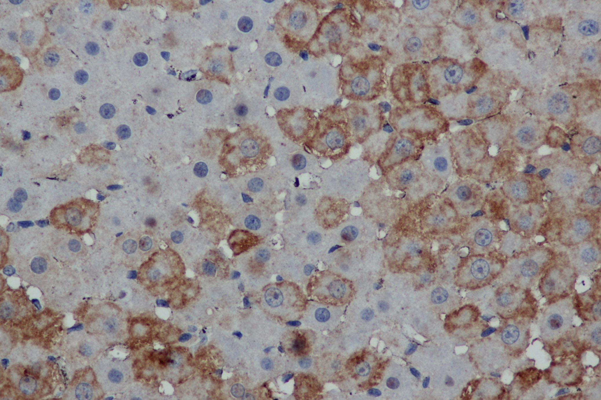 Immunohistochemistry of paraffin-embedded Human thyroid cancer tissue using MPO Polyclonal Antibody at dilution 1:50