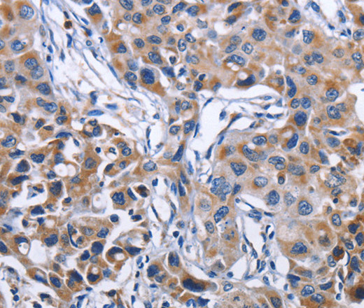 Immunohistochemistry of paraffin-embedded Human lung cancer tissue using MPO Polyclonal Antibody at dilution 1:50