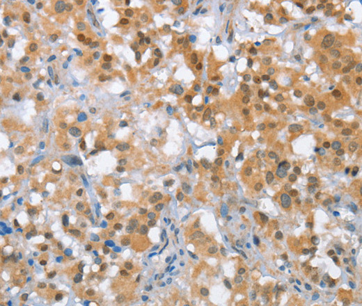 Immunohistochemistry of paraffin-embedded Human thyroid cancer tissue using MLH1 Polyclonal Antibody at dilution 1:65