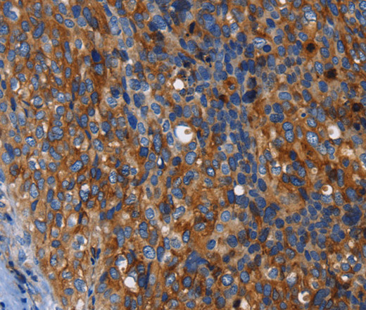 Immunohistochemistry of paraffin-embedded Human cervical cancer tissue using MSLN Polyclonal Antibody at dilution 1:50
