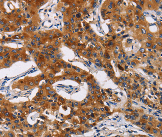 Immunohistochemistry of paraffin-embedded Human lung cancer tissue using MSLN Polyclonal Antibody at dilution 1:50