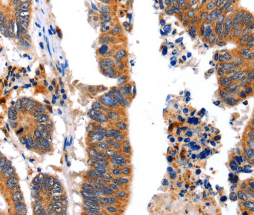 Immunohistochemistry of paraffin-embedded Human colon cancer using NCK1 Polyclonal Antibody at dilution of 1:30