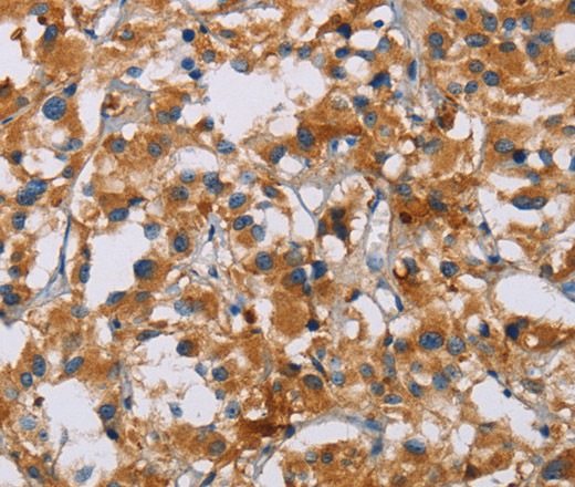 Immunohistochemistry of paraffin-embedded Human thyroid cancer tissue using NRN1 Polyclonal Antibody at dilution of 1:40