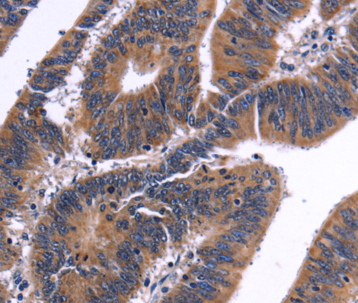 Immunohistochemistry of paraffin-embedded Human colon cancer tissue using NFATC3 Polyclonal Antibody at dilution 1:50