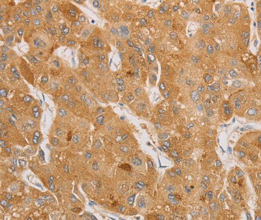 Immunohistochemistry of paraffin-embedded Human liver cancer tissue using NGF Polyclonal Antibody at dilution 1:50