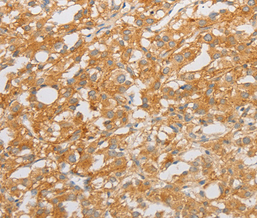 Immunohistochemistry of paraffin-embedded Human thyroid cancer tissue using NGF Polyclonal Antibody at dilution 1:50