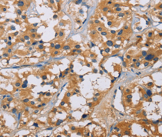 Immunohistochemistry of paraffin-embedded Human thyroid cancer tissue using NME5 Polyclonal Antibody at dilution 1:50