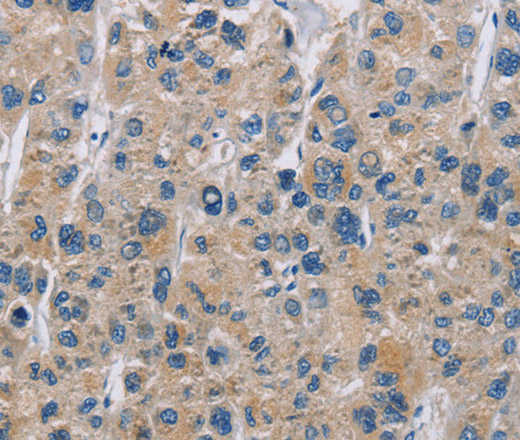 Immunohistochemistry of paraffin-embedded Human liver cancer tissue using NME5 Polyclonal Antibody at dilution 1:50