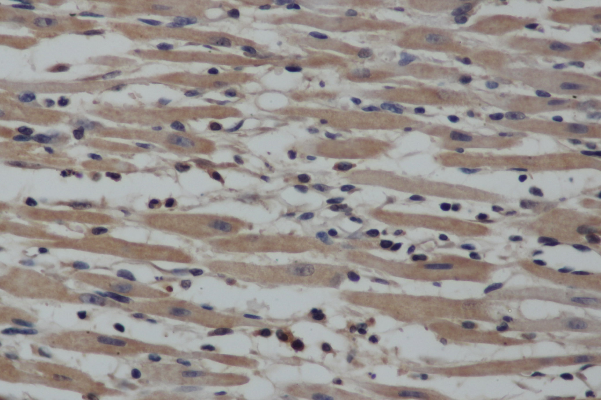 Immunohistochemistry of paraffin-embedded Human gasrtic cancer tissue using NOS2 Polyclonal Antibody at dilution 1:40