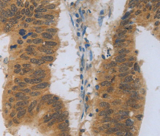 Immunohistochemistry of paraffin-embedded Human colon cancer using TNFRSF11B Polyclonal Antibody at dilution of 1:30