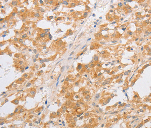 Immunohistochemistry of paraffin-embedded Human thyroid cancer tissue using CDKN2AIP Polyclonal Antibody at dilution 1:40