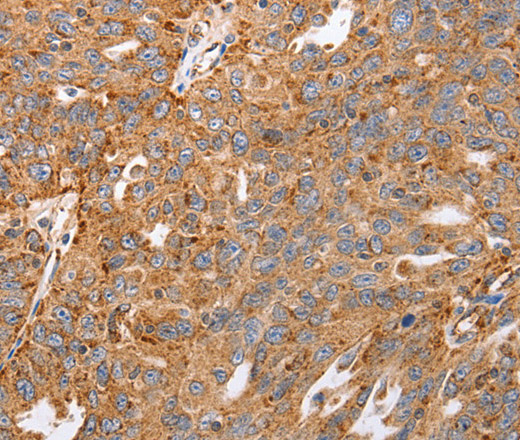 Immunohistochemistry of paraffin-embedded Human ovarian cancer tissue using MAP2K5 Polyclonal Antibody at dilution 1:40