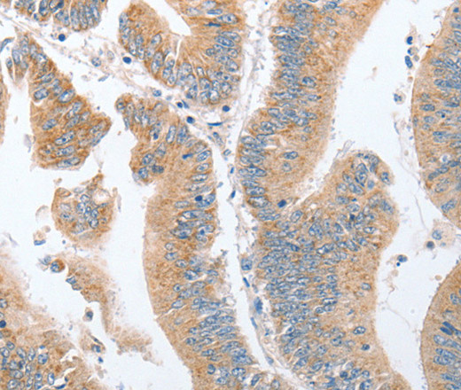 Immunohistochemistry of paraffin-embedded Human colon cancer tissue using PARD6A Polyclonal Antibody at dilution 1:60