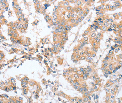 Immunohistochemistry of paraffin-embedded Human breast cancer tissue using PARD6A Polyclonal Antibody at dilution 1:60
